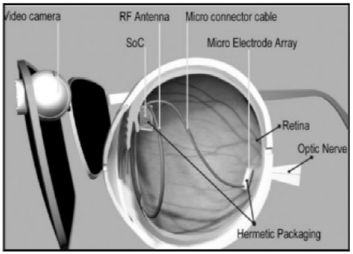 人工视网膜假体利用外装的图像处理装置捕捉和处理图像信息,对视网膜进行电刺激,产生可视图像