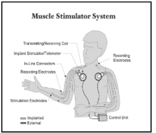 肌肉刺激系统