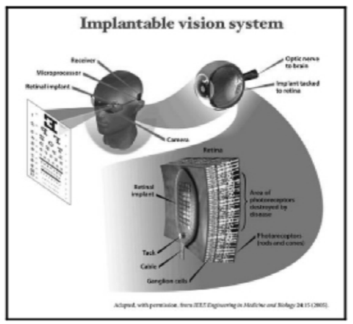 植入式视觉系统