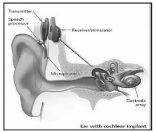 耳蜗内的小电极可激活听觉神经,并将电子信号传送到大脑